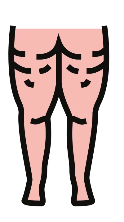Illustrazione di gambe con la cellulite